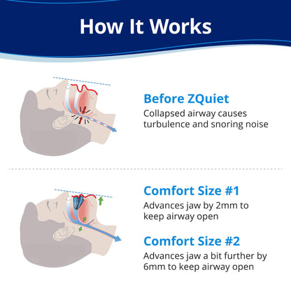 ZQuiet, Anti-Snoring Mouthpiece, Starter Pack with 2 Sizes, Living Hinge & Open Front Design for Comfort & Easy Breathing, Clear